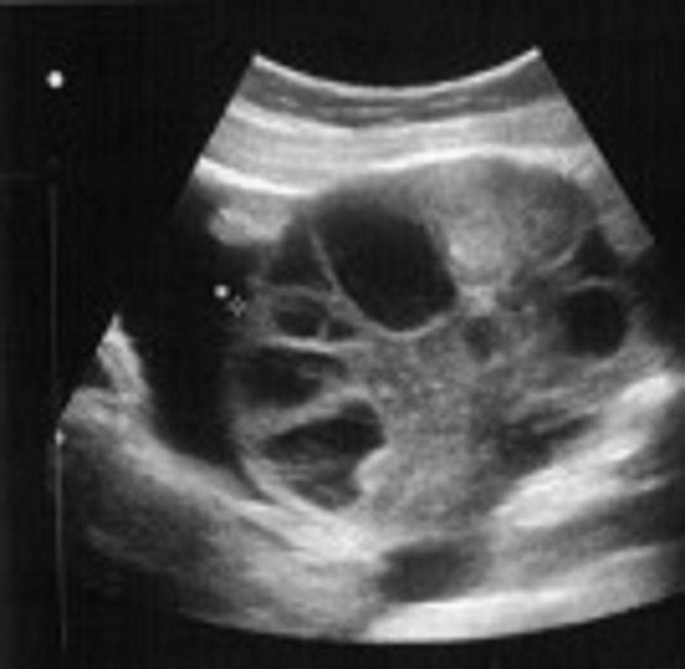 Højre ovarie fem dage efter oocytaspiration, der ses begyndende ascitesdannelse (ovariet måler 94 × 78 mm).