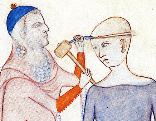 Middelalderens læger var længere fremme, end man lige går og tror. Selv komplicerede indgreb som &quot;det hvide snit&quot; mestrede de, som det fremgår af denne illustration fra 1400-tallet.