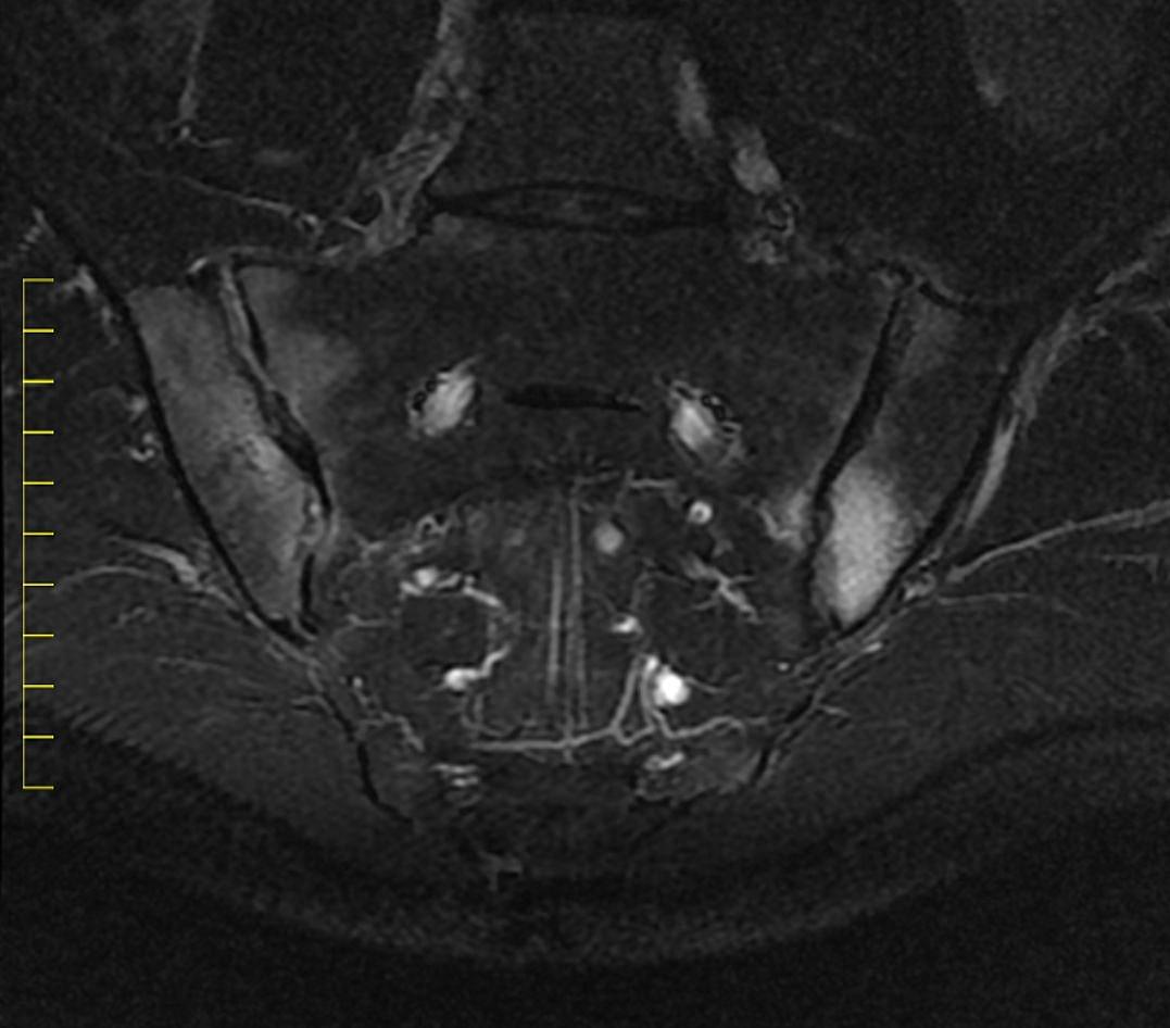 MR-billede af bækken og nedre ryghvirvler. Betændelsen lyser op og er derfor nem at se.
Foto: Mikkel Østergaard