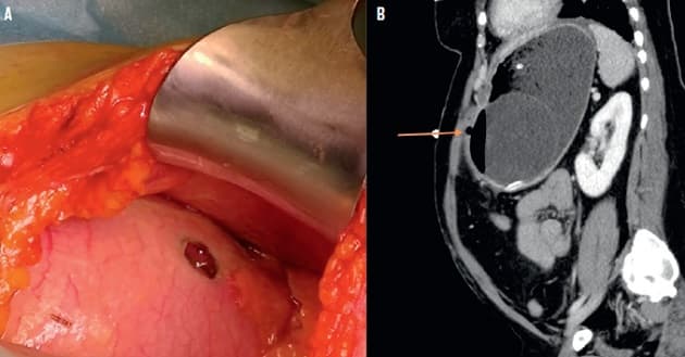 © Fund af ventrikelperforation