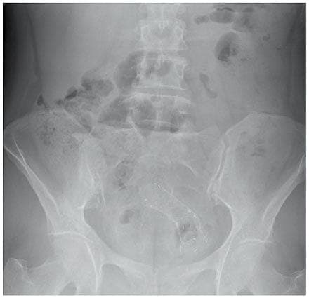 Stent i colon sigmoideum.