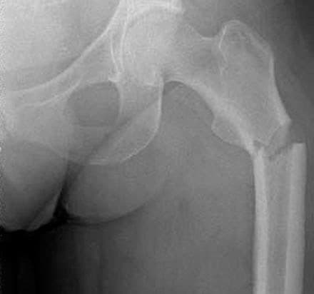 Atypisk femurfraktur hos en 51-årig kvinde, der var i behandling med lamotrigin.