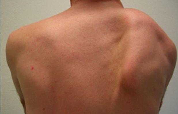 Voksen mandlig patient med højresidig englevinge forårsaget af serratus anterior-insufficiens under forsøg på løft af armen.