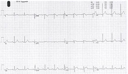 Ekg fra en patient med Brugadas syndrom (BS). Hos patienter med BS vil ekg-forandringer ofte ses med højresidigt grenblok og ST-elevation efterfulgt af negativ T-tak i mindst to af afledningerne i V1-V3.