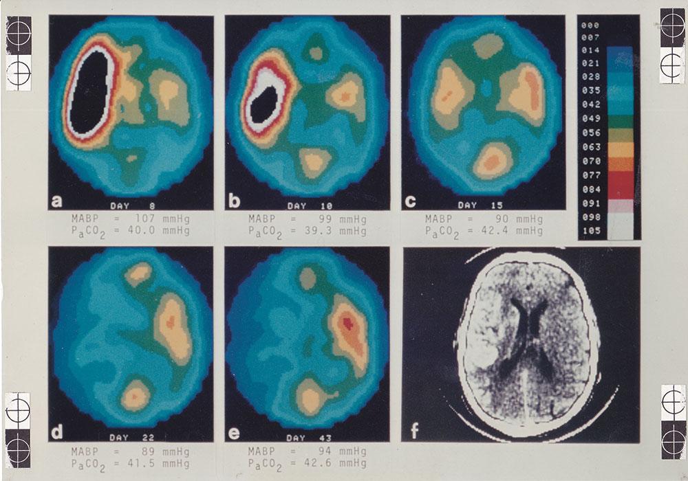 Tomografisk snit der viser det regionale blodflow i hjernen hos en patient med en stor læsion i højre hemisfære. I læsionen ses nedsat centralt blodflow med hyperæmi i randzonen. Dette svinder ved gentagne undersøgelser over de næste 47 dage. Undersøgelsen er udført i 1985 med tomografen Tomomatic-64 og inhalation af xenon-133 (Fra Niels A. Lassens lysbilledsamling).