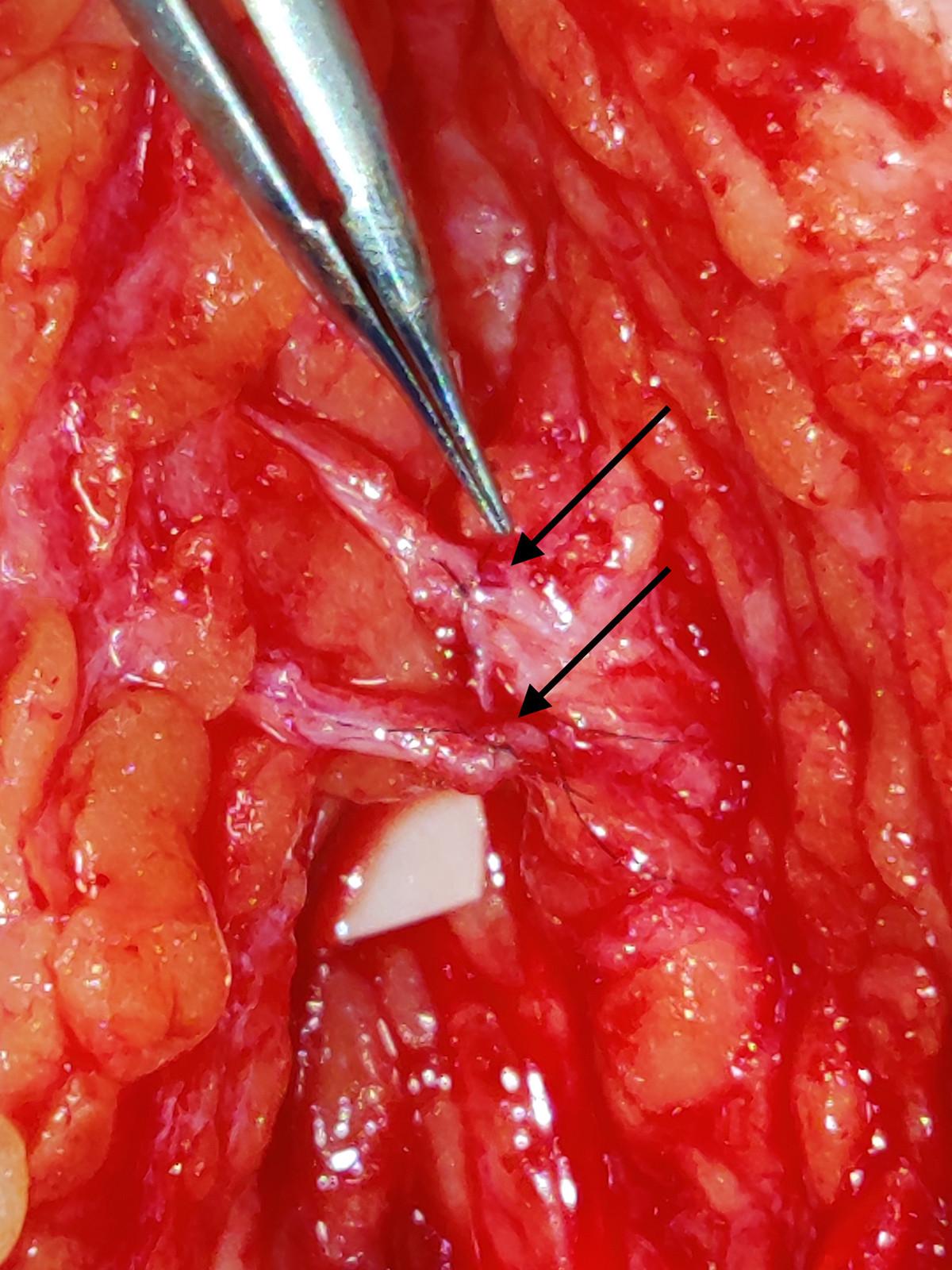 End-to-end-neurorafi. Mikrokirurgisk suturering af læderede nerveender ved end-to-end-metode af rami temporales n. facialis. De sorte pile indikerer, hvor nerveenderne er adapteret og sutureret med nylon 9-0.