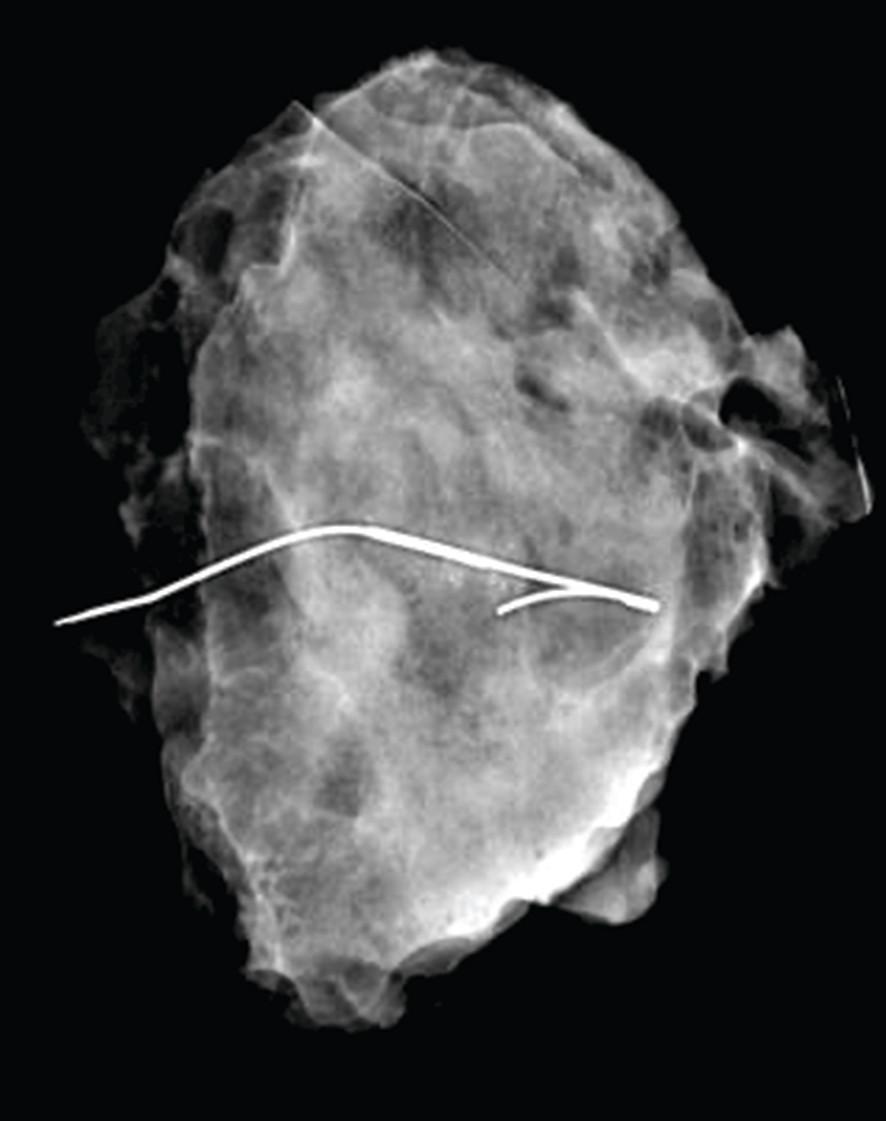 Røntgenbillede af lumpektomipræparat. Her ses nålemarkeringen midt i forandringen og med frie resektionsrande. Langs nålen ses et område med mikroforkalkninger. 