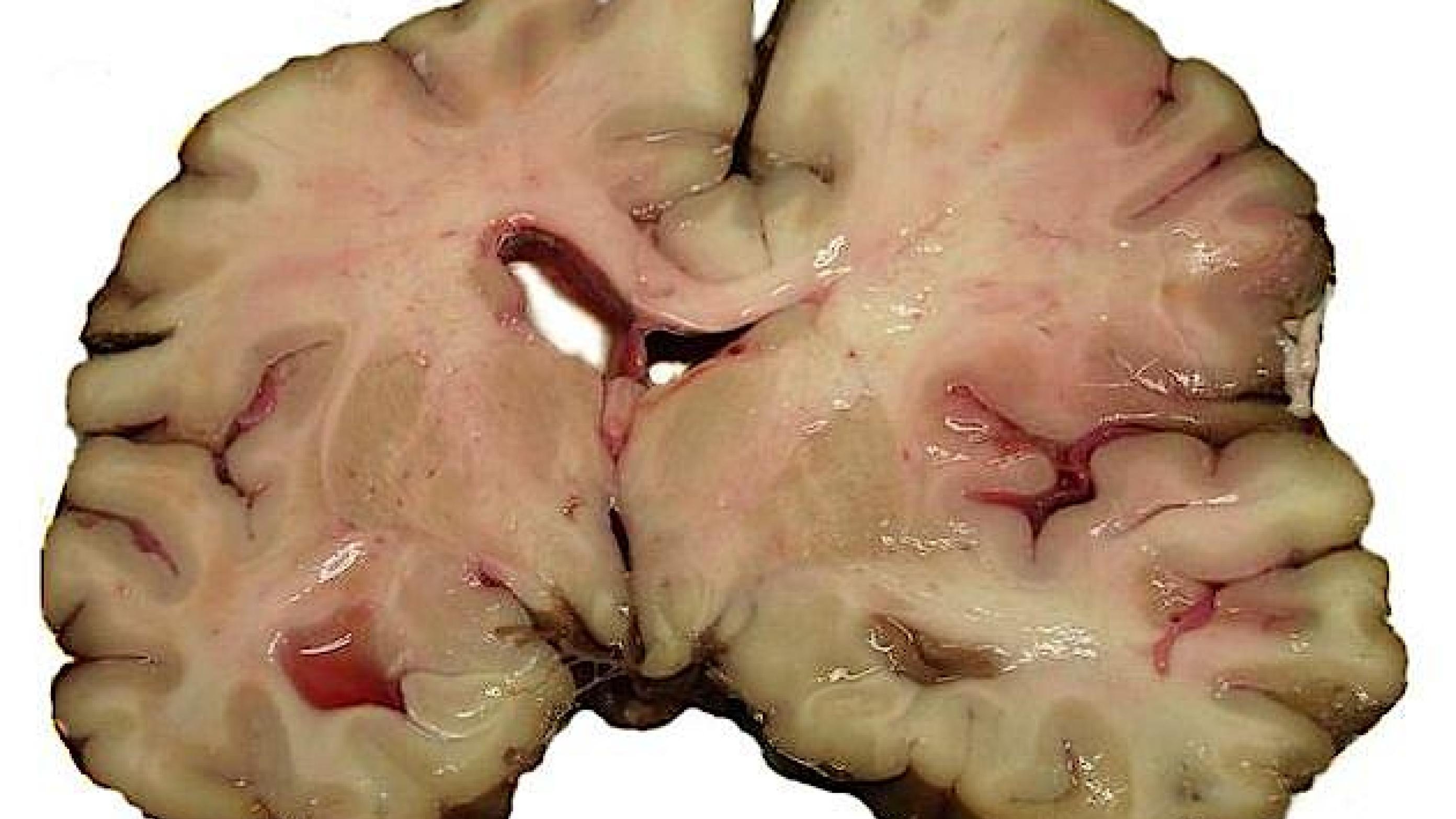 Hjerneblodprop (Foto: Wikimedia Commons)