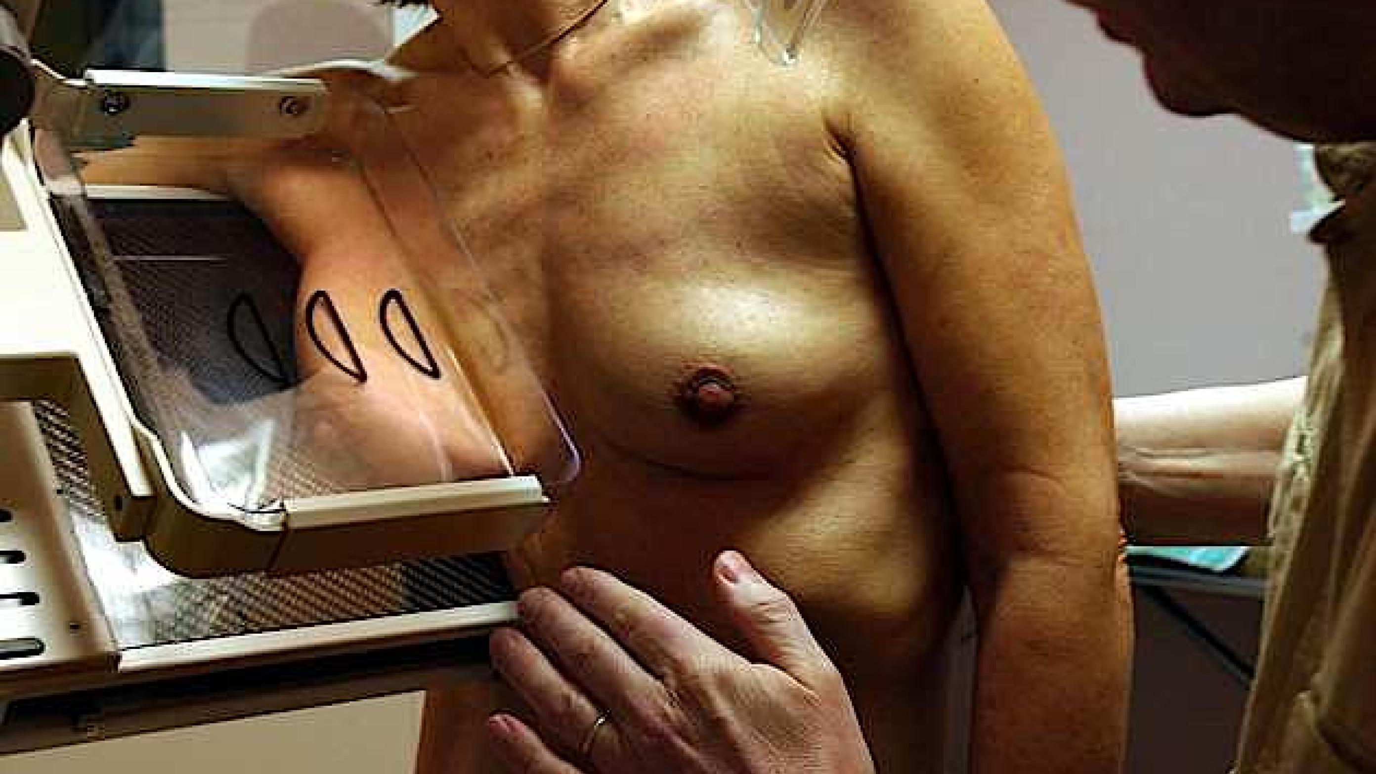 Administrativt blev over 18.000 kvinder slettet fra brystkræftscreening-programmet.