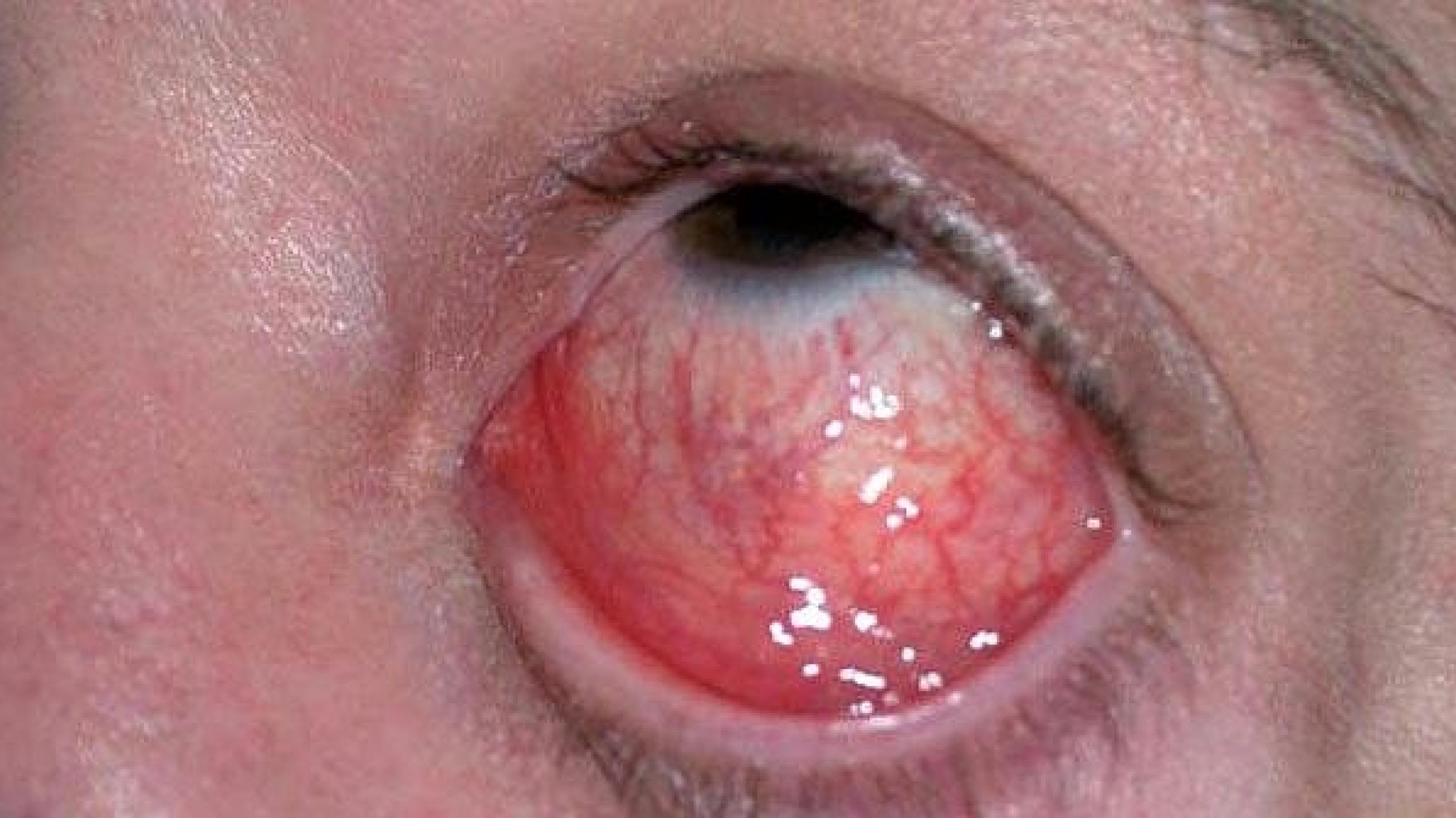 Øjenbetændelse (conjunctivitis) forårsaget af Neisseria gonorrhoeae.