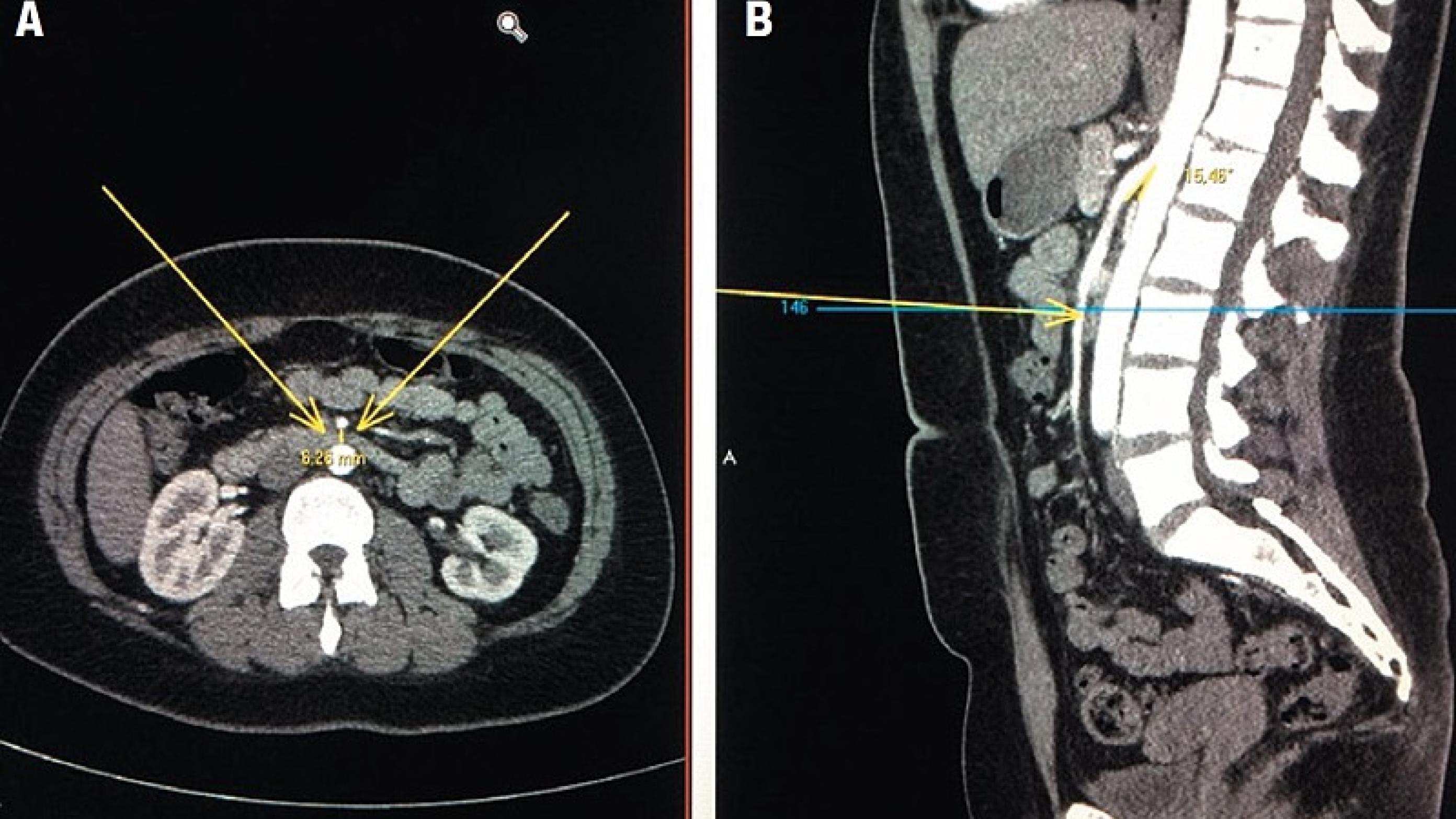 CT-billede af abdomen med intravenøs kontrast