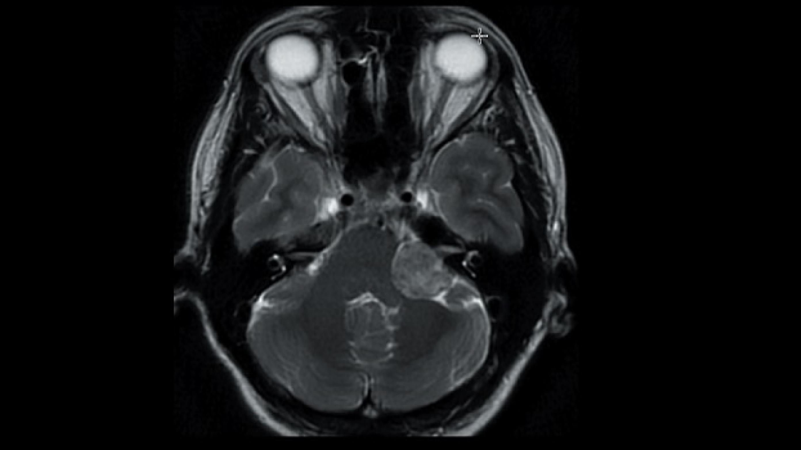 © . Venstresidigt vestibularisschwannom beliggende i den cerebellopontine vinkel med let kompression af hjernestamme og cerebellum.