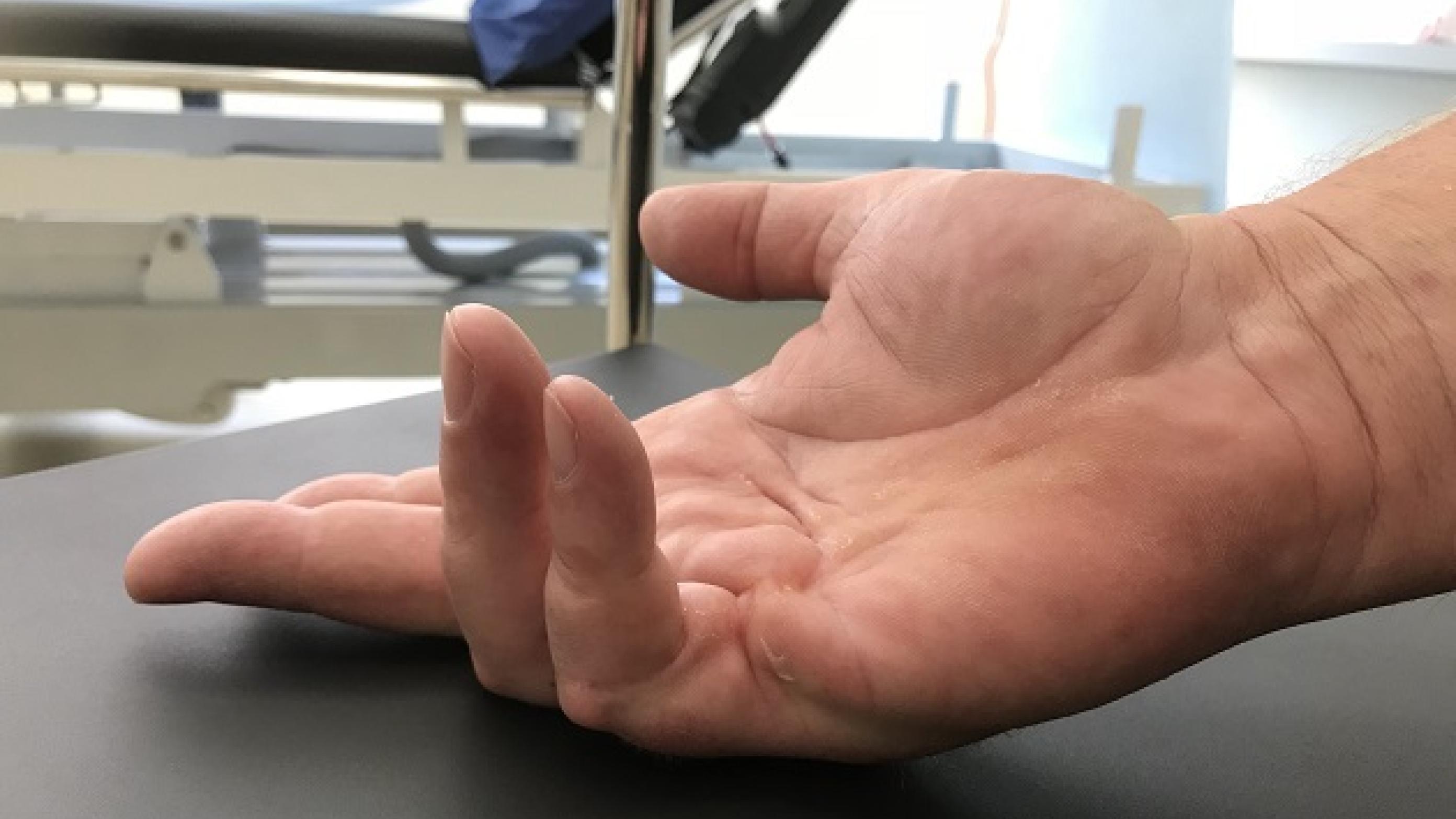 A 66-year-old male with needle fasciectomy of the fifth finger proximal interphalangeal (PIP) joint