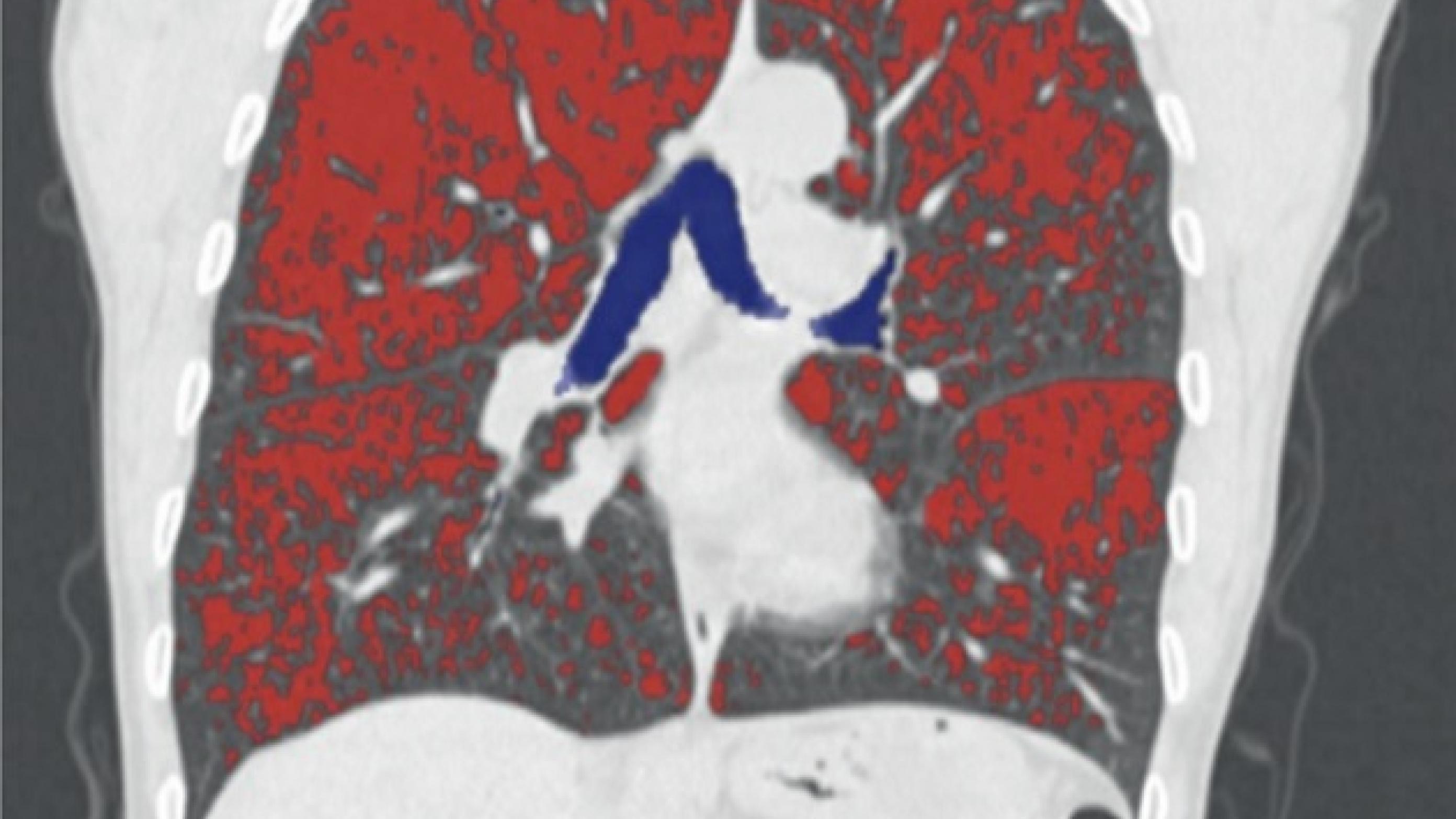 © Med CT-software visualiseres emfysemfordelingen i lungerne, markeret med rødt.