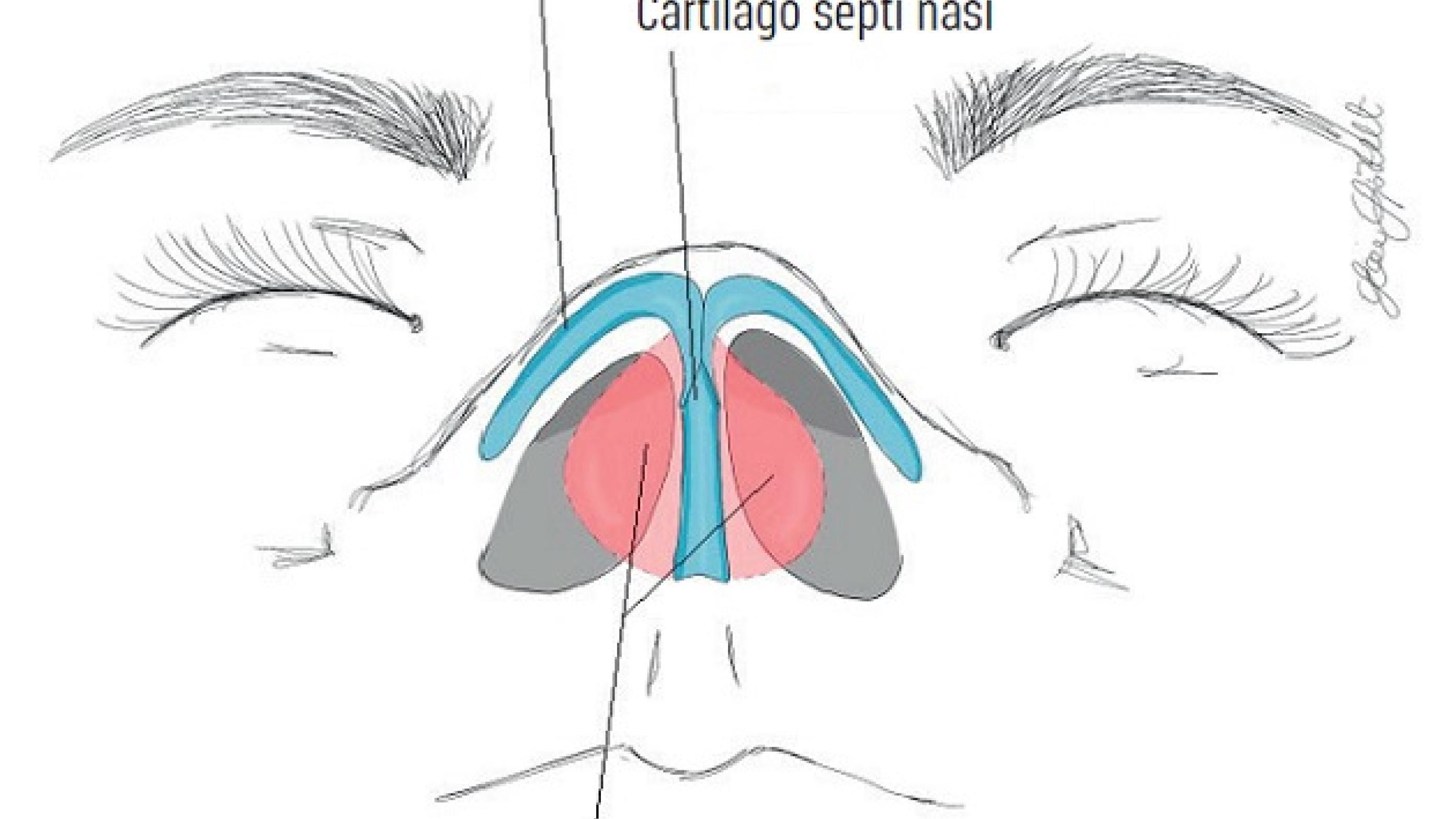© Bilateralt septumhæmatom, der ses som en rødlig frembuling på det nasale septum.