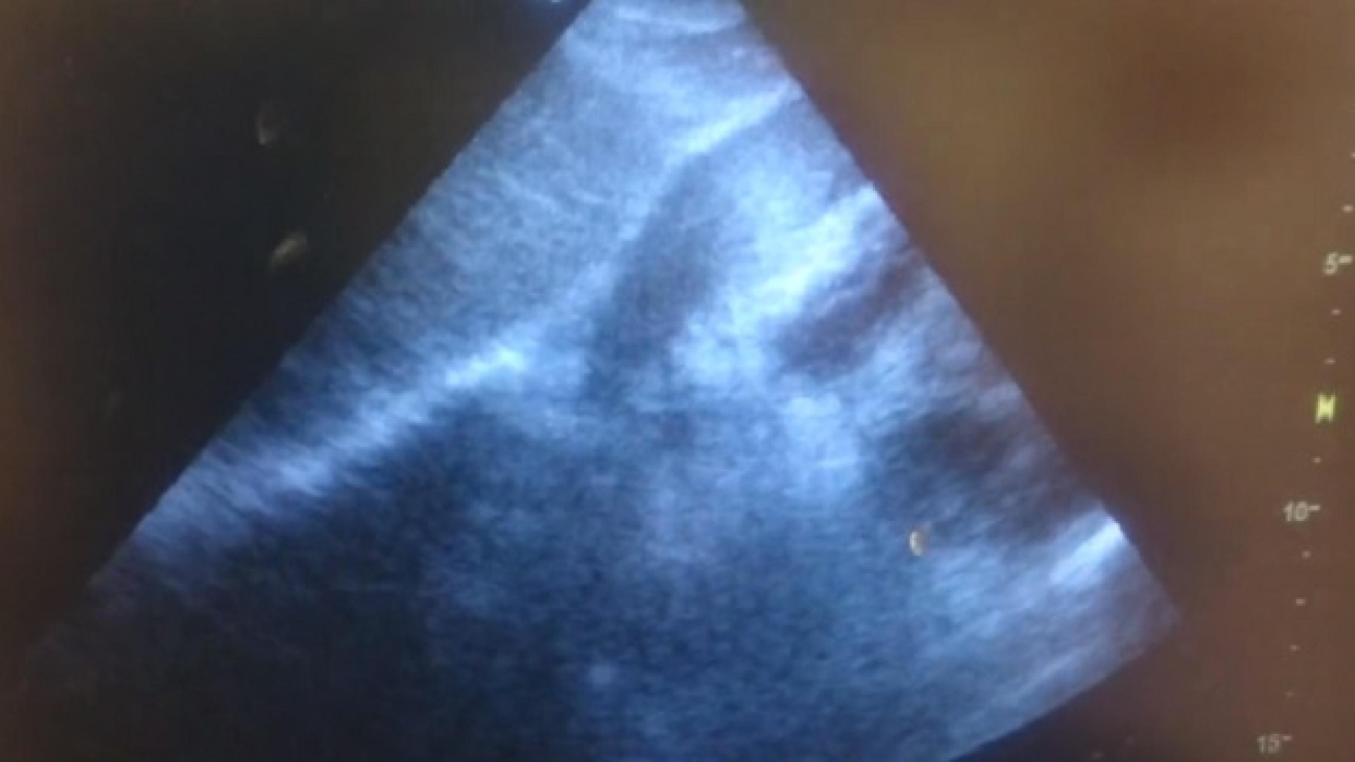 Se video af ultralyd i artiklen.