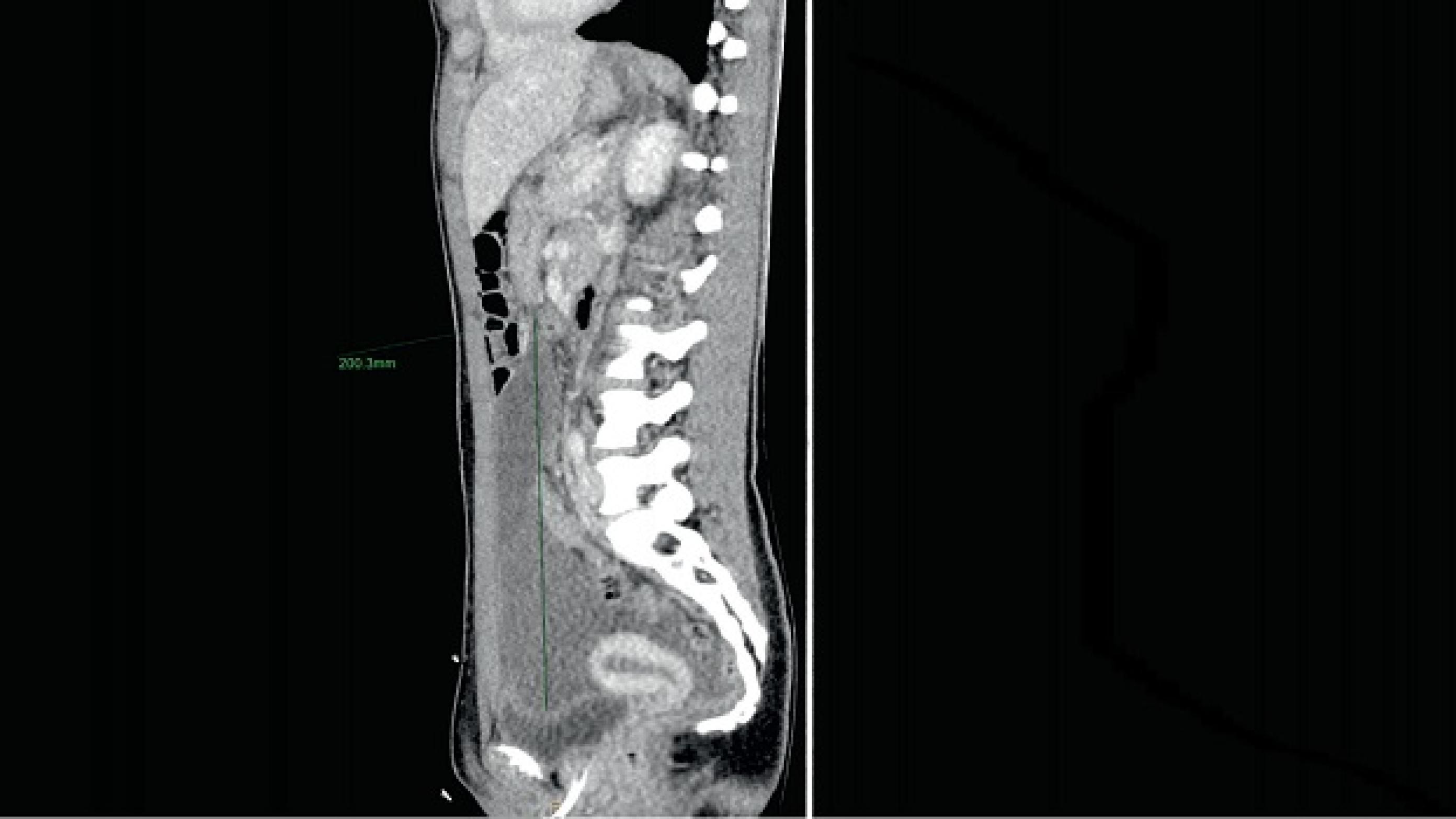 CT-sidebillede af cyste. ©