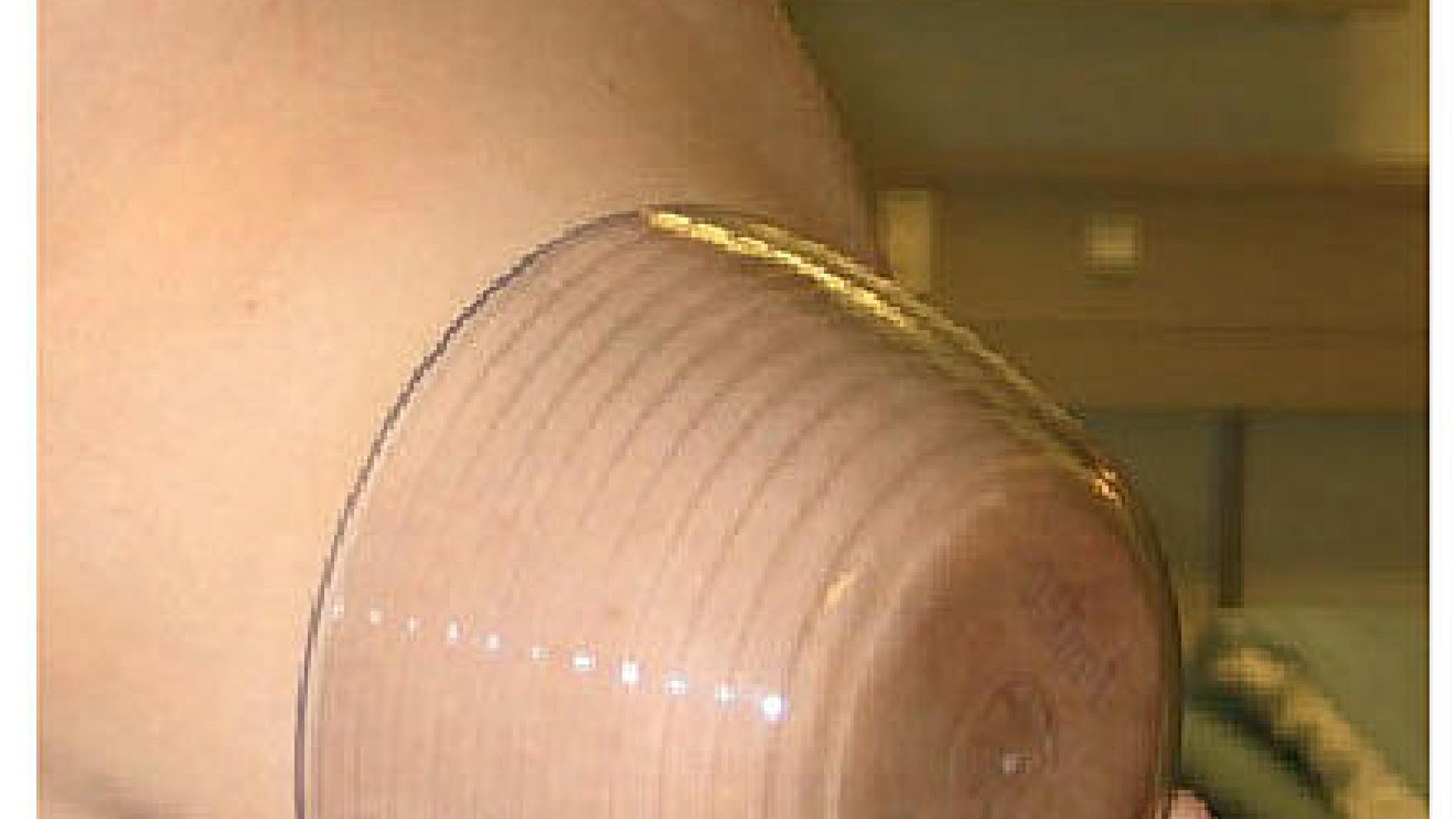 Breast volume measurement using transparent plastic cup.