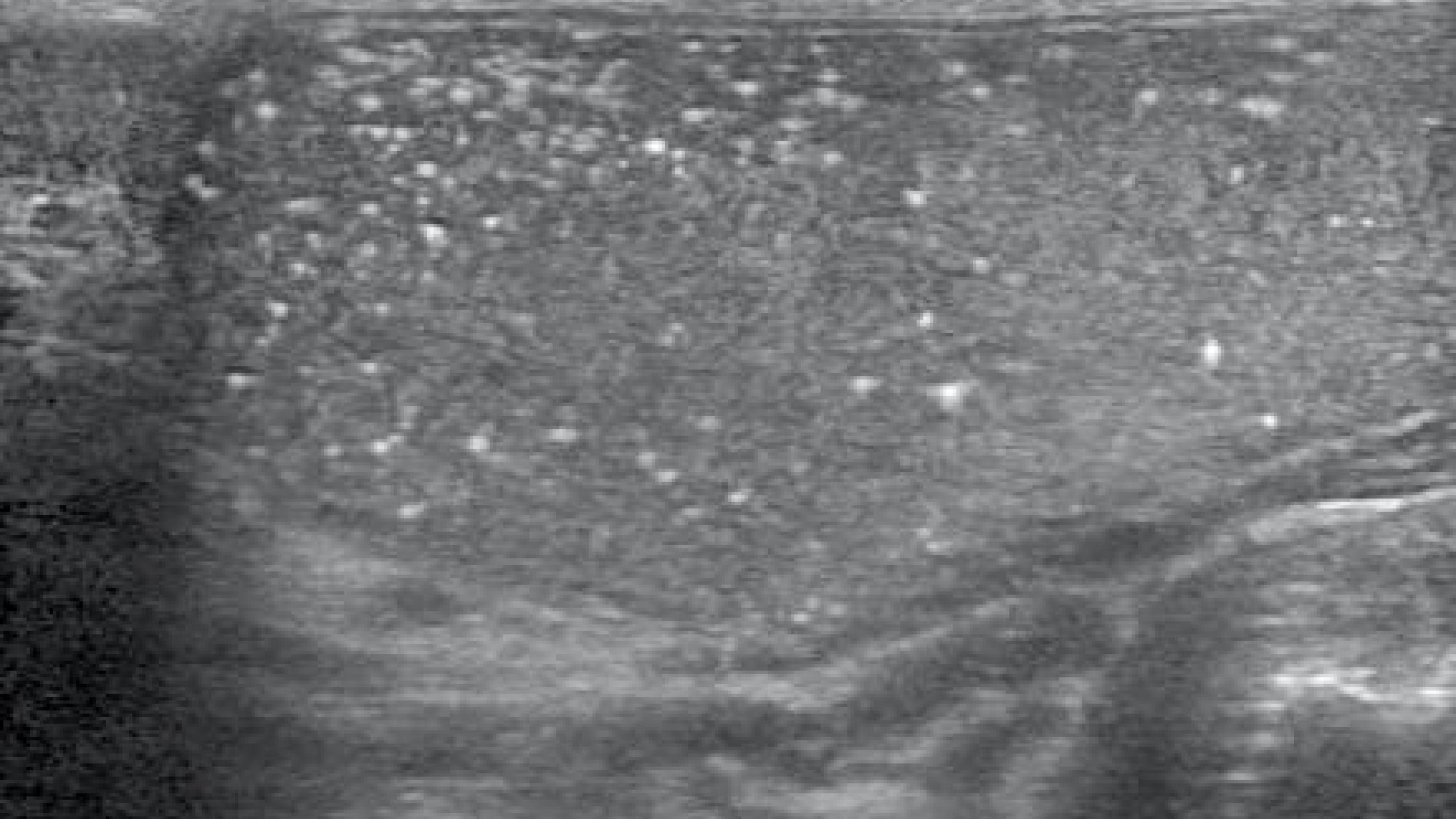 Et eksempel på testikulær microlithiasis fundet ved ultralydskanning. Man har ikke kunnet vise, at antallet af mikroforkalkninger har betydning for patientens prognose.