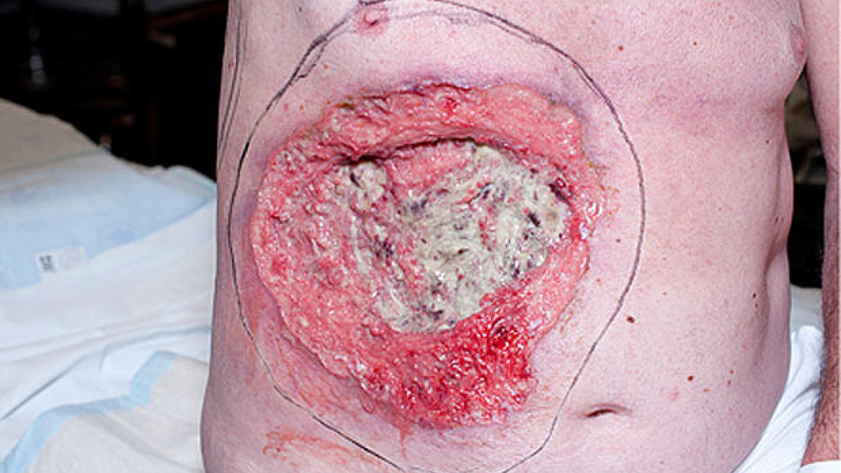 Et kronisk sår på abdomen begyndte efter 15 år at vokse hurtigt med tiltagende sivning og ildelugt. Stansebiopsier viste lavt differen­tieret basoskvamøst kar­cinom.