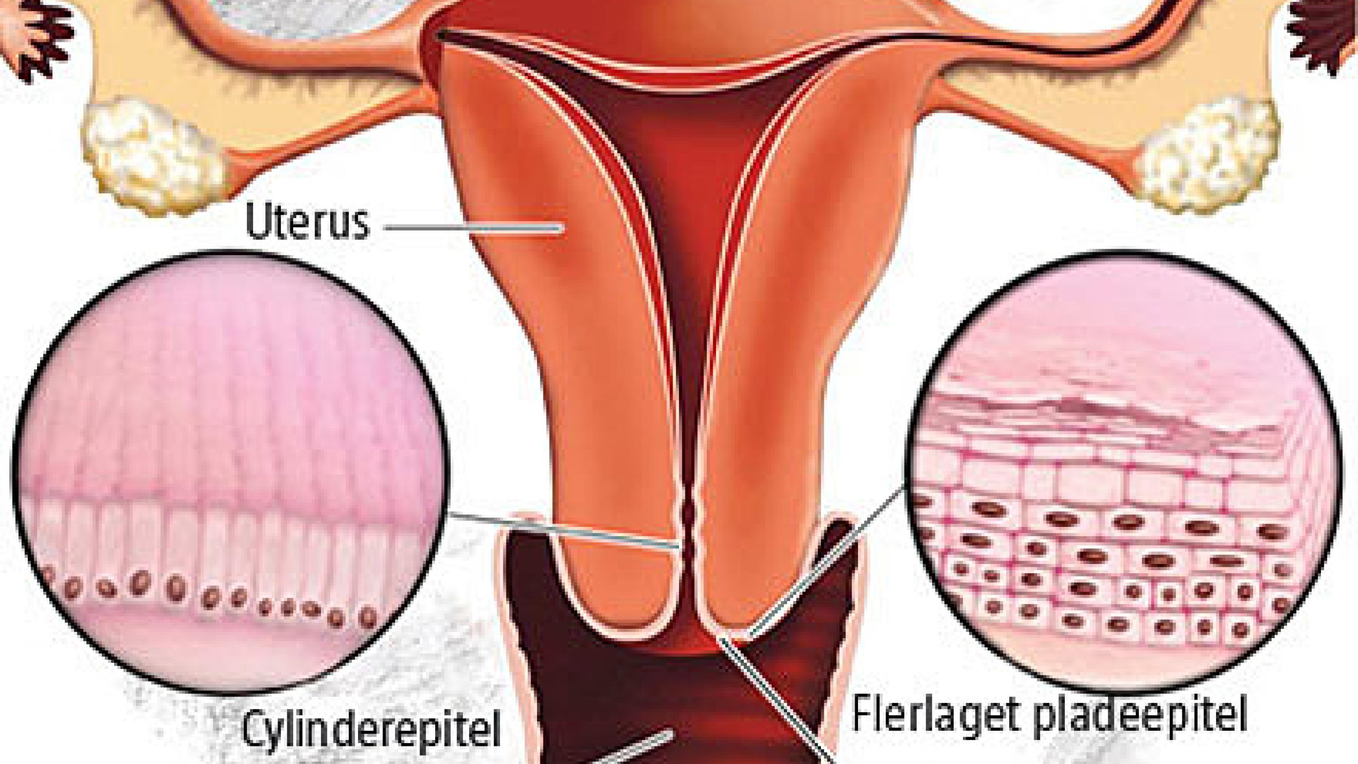 Koronalt snit af uterus og vagina. 