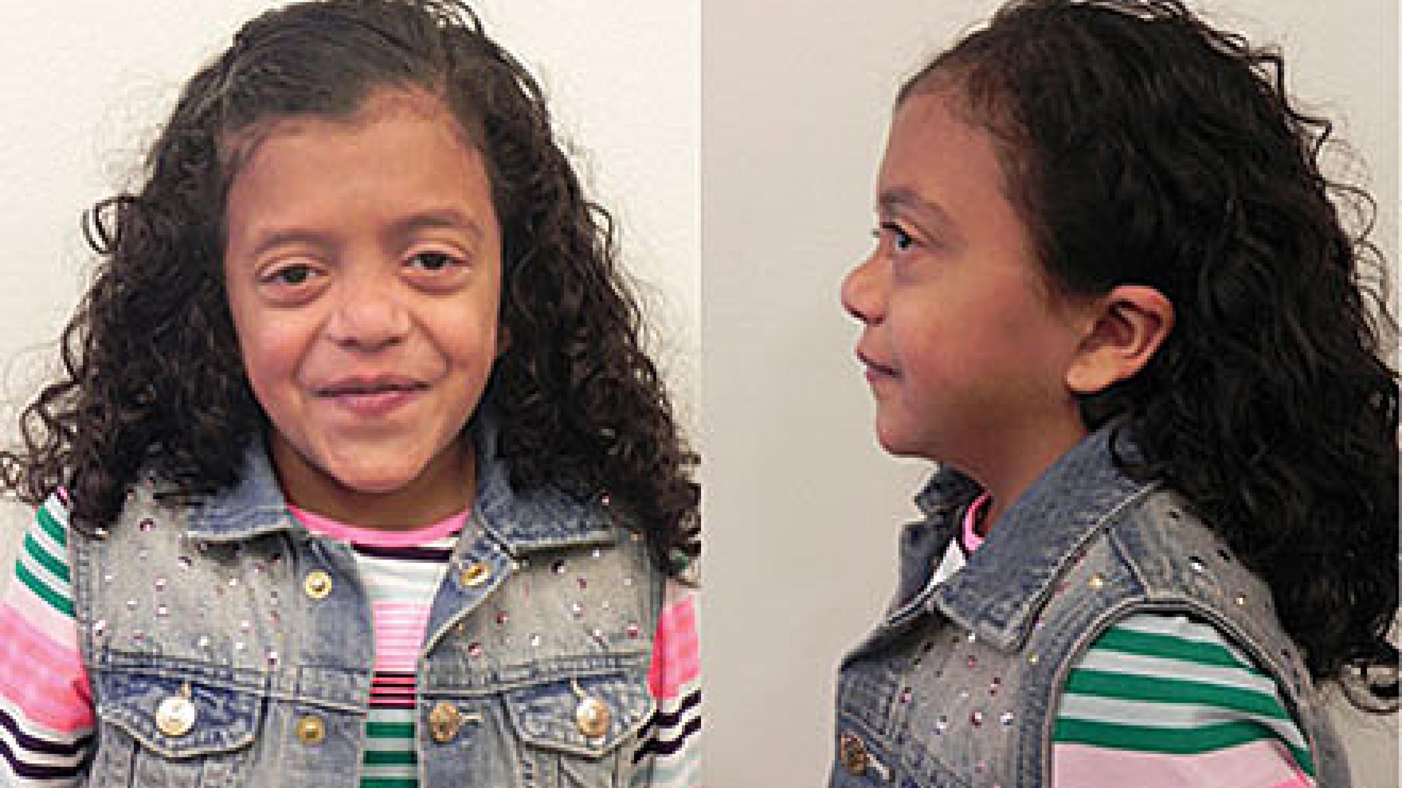 Niårig pige med Noonans syndrom og mutation i PTPN11: c.178G>A; p.(Gly60Ser) i heterozygot form.