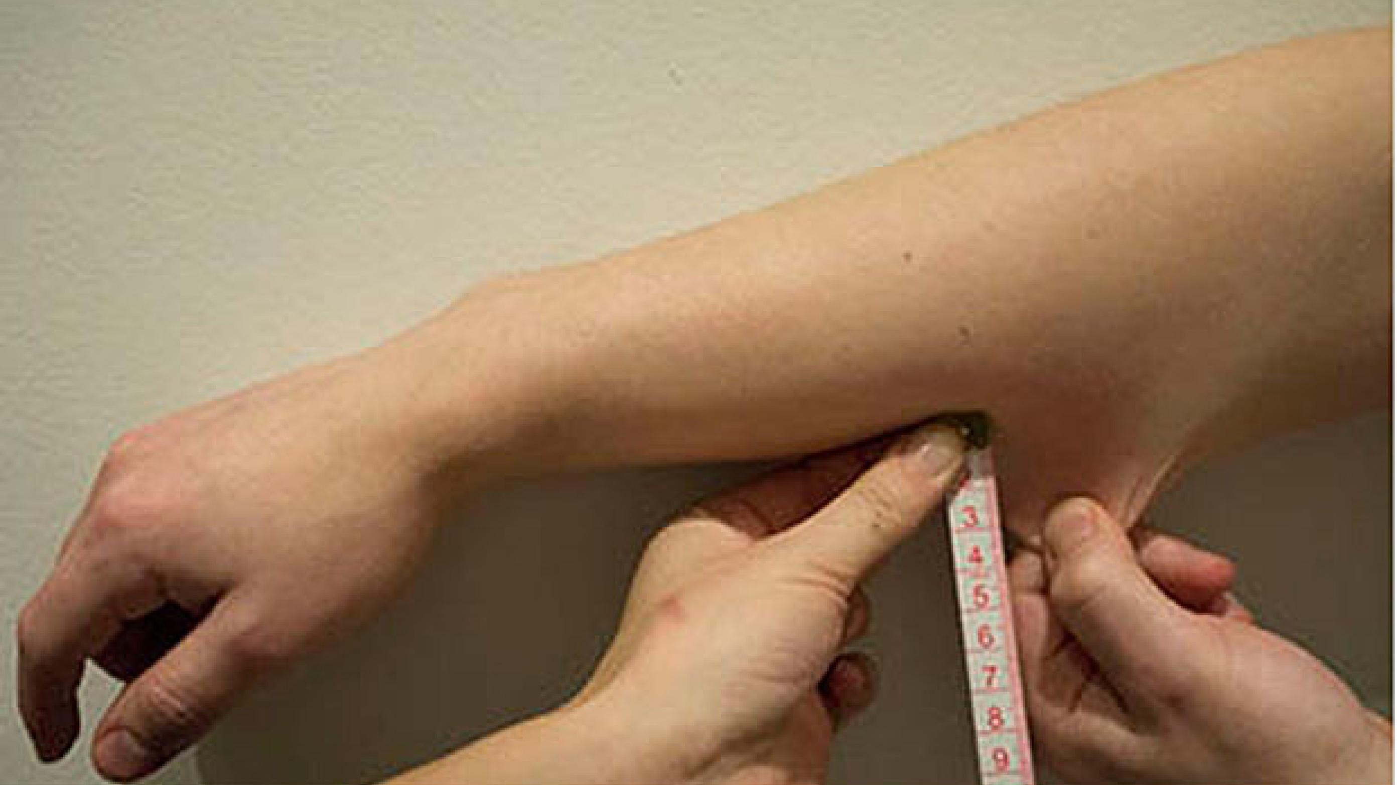 Klinisk undersøgelse af hudens overtrækbarhed testes på volarsiden af underarmen. 