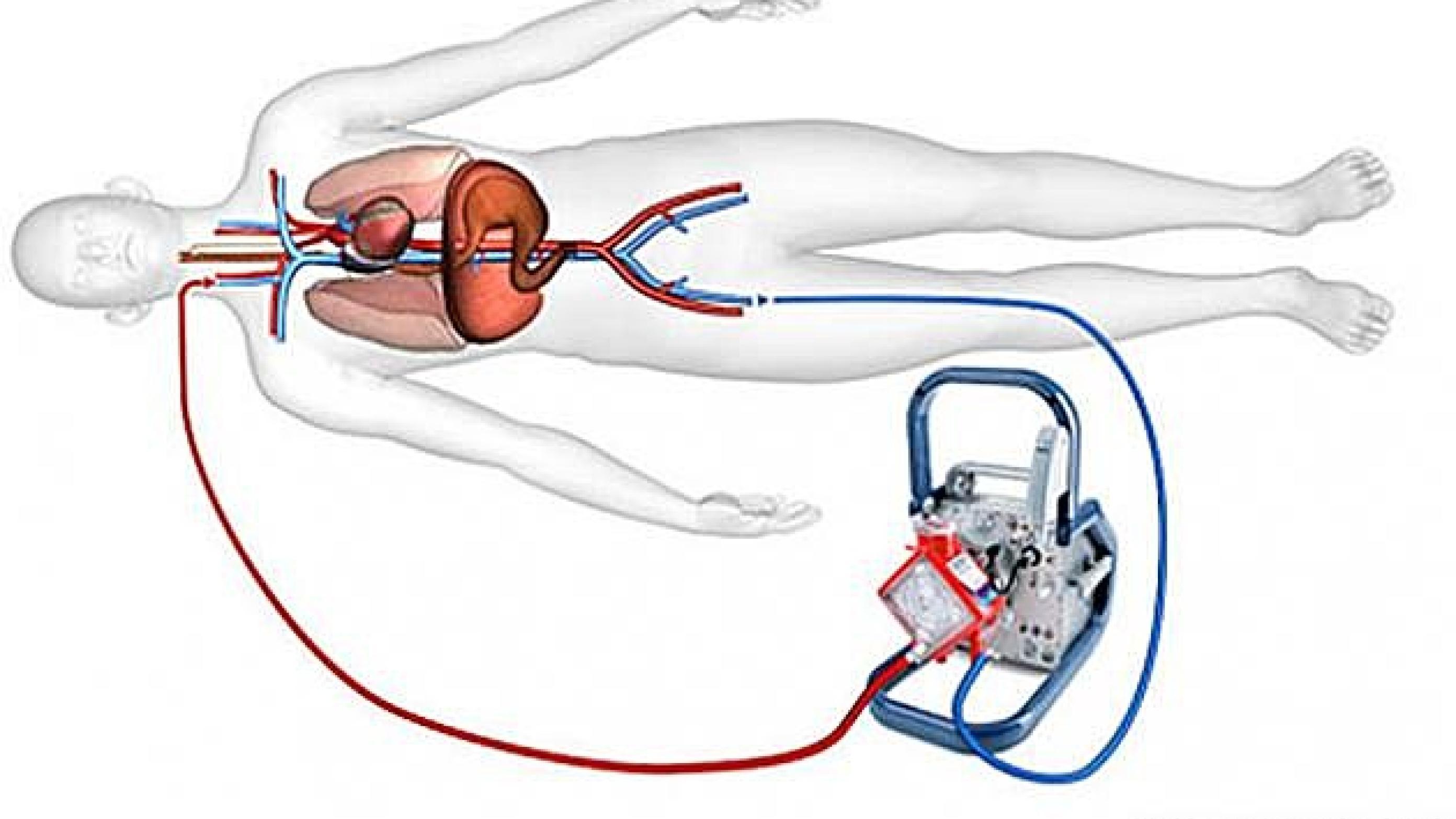 Ved veno-venøs ekstrakorporal membranoxygenering pumpes venøst blod ud via et kateter i vena femoralis, hvorefter det iltes, og CO2 udluftes. Illustrationen er bragt med tilladelse fra Maquet Nordic, www.maguet.com.