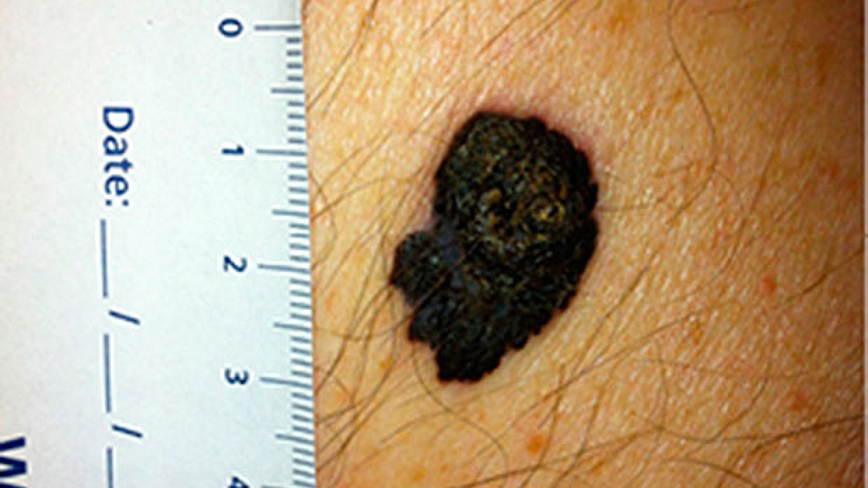 Et superficielt spredende melanom. 