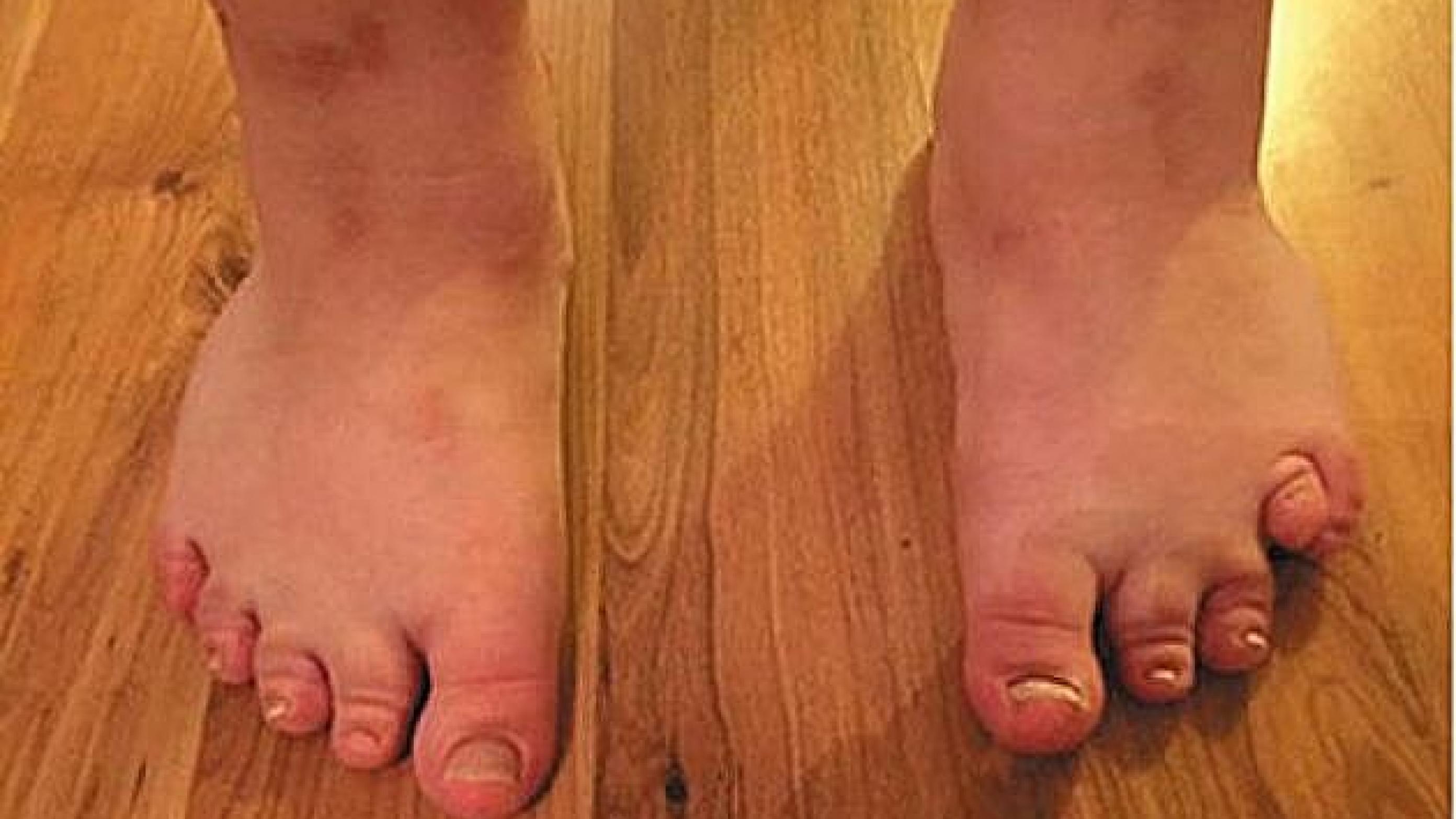 På billedet ses en karakteristisk kort fjerde tå (brakydaktyli) på venstre fod hos sygehistoriens patient med Albrights hereditære osteodystrofi.