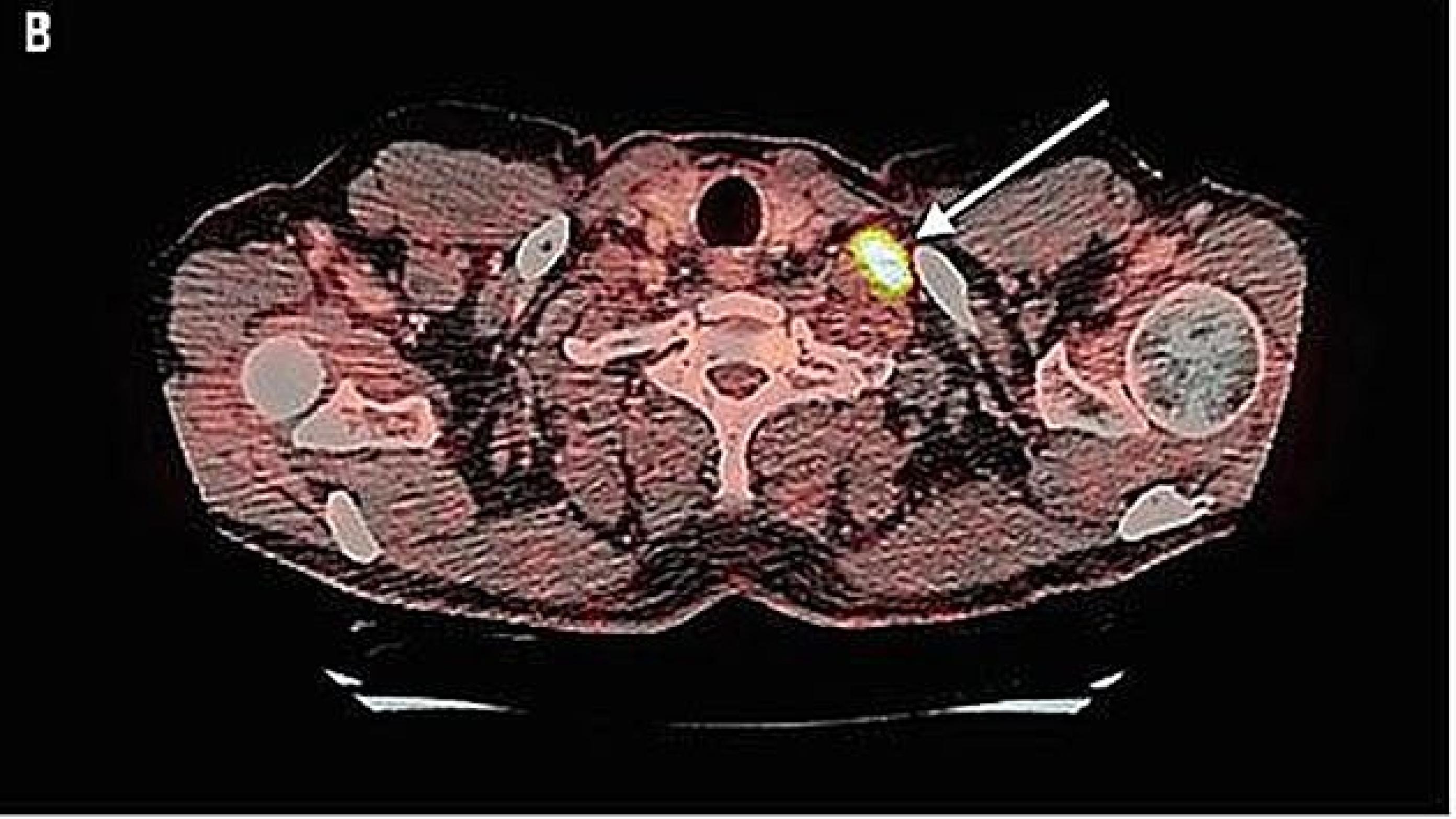 PET-CT i aksialt snit. Pilen viser den FDG-positive lymfeknude på halsen. Ill. fra artiklen.