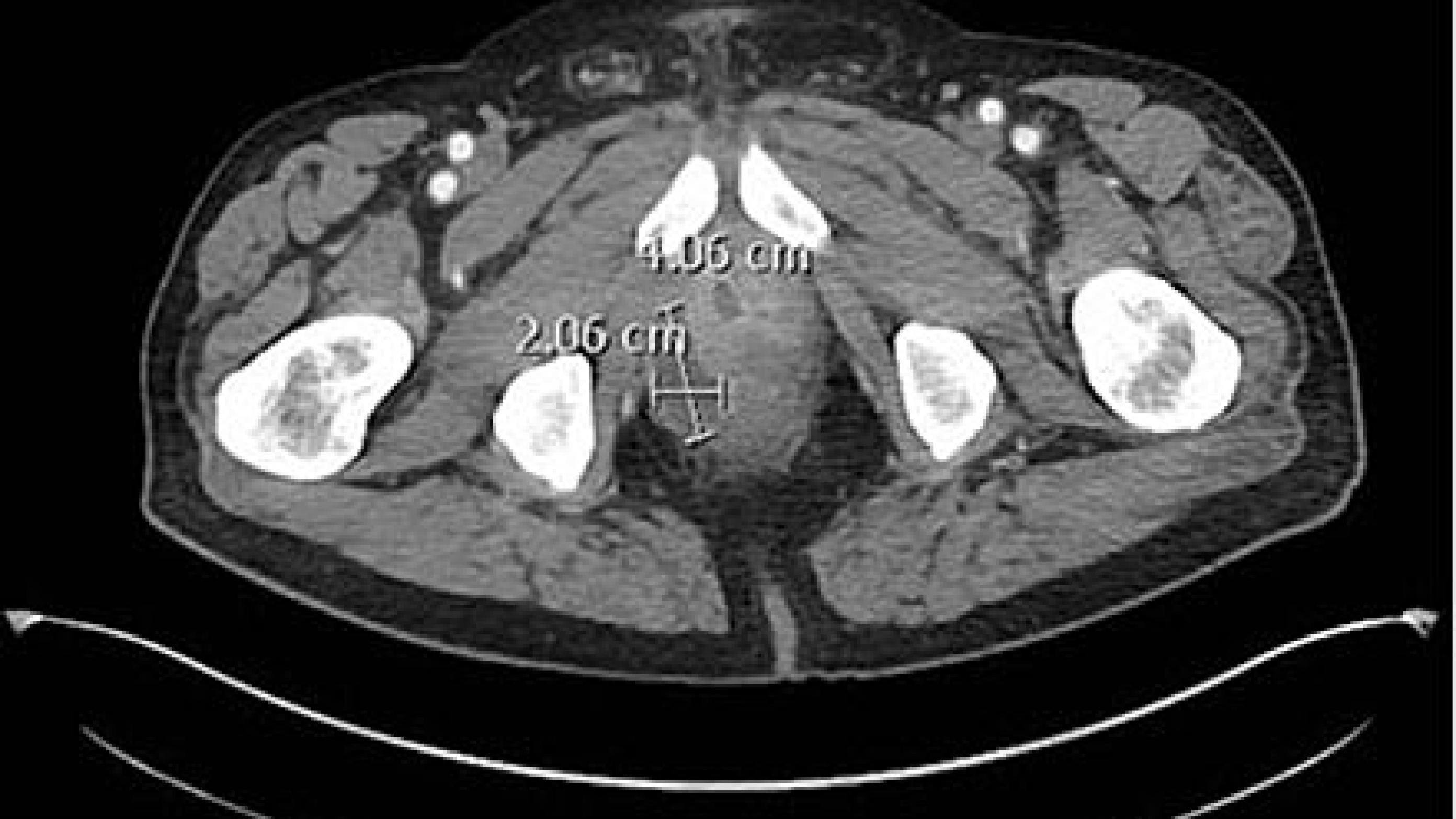 CT-billede, der viser en perirektal absces på ca. 4 × 2 cm med kommunikation til prostata.