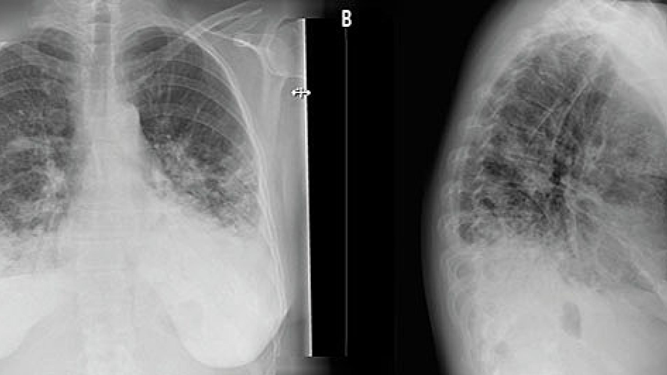 Bilateral Mycoplasma-pneumoni med vattede infiltrative forandringer. A. Frontalplan. B. Sagittalplan.