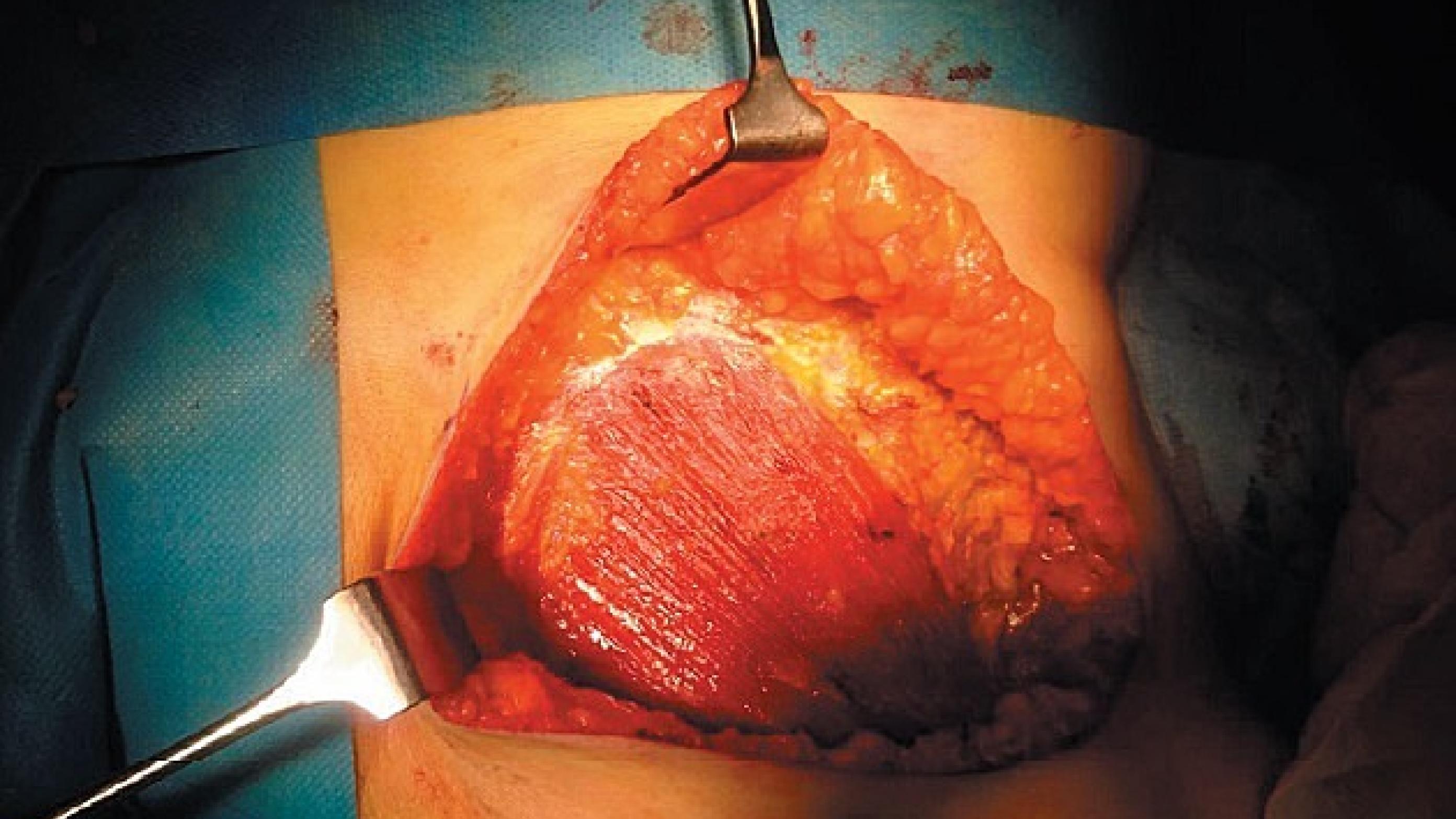 Mastektomioperation. Pectoralismuskulatur efter fjernelse af brystvævet.