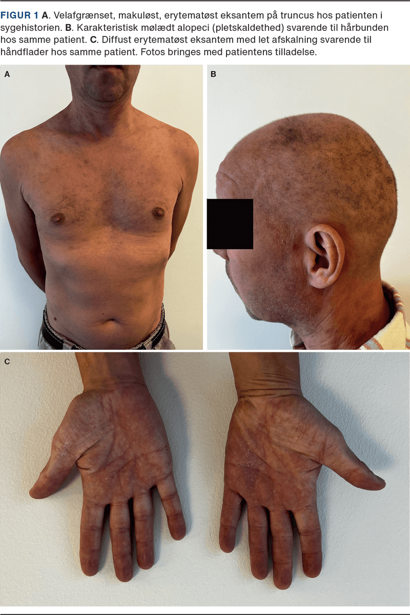 Syphilis visual data 5