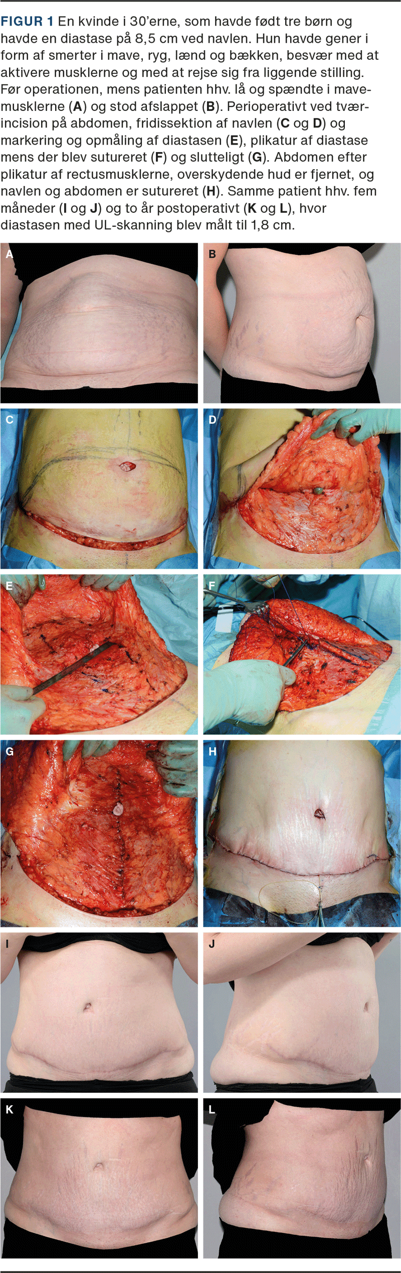 A new minimally invasive technique for the repair of diastasis recti: a  pilot study