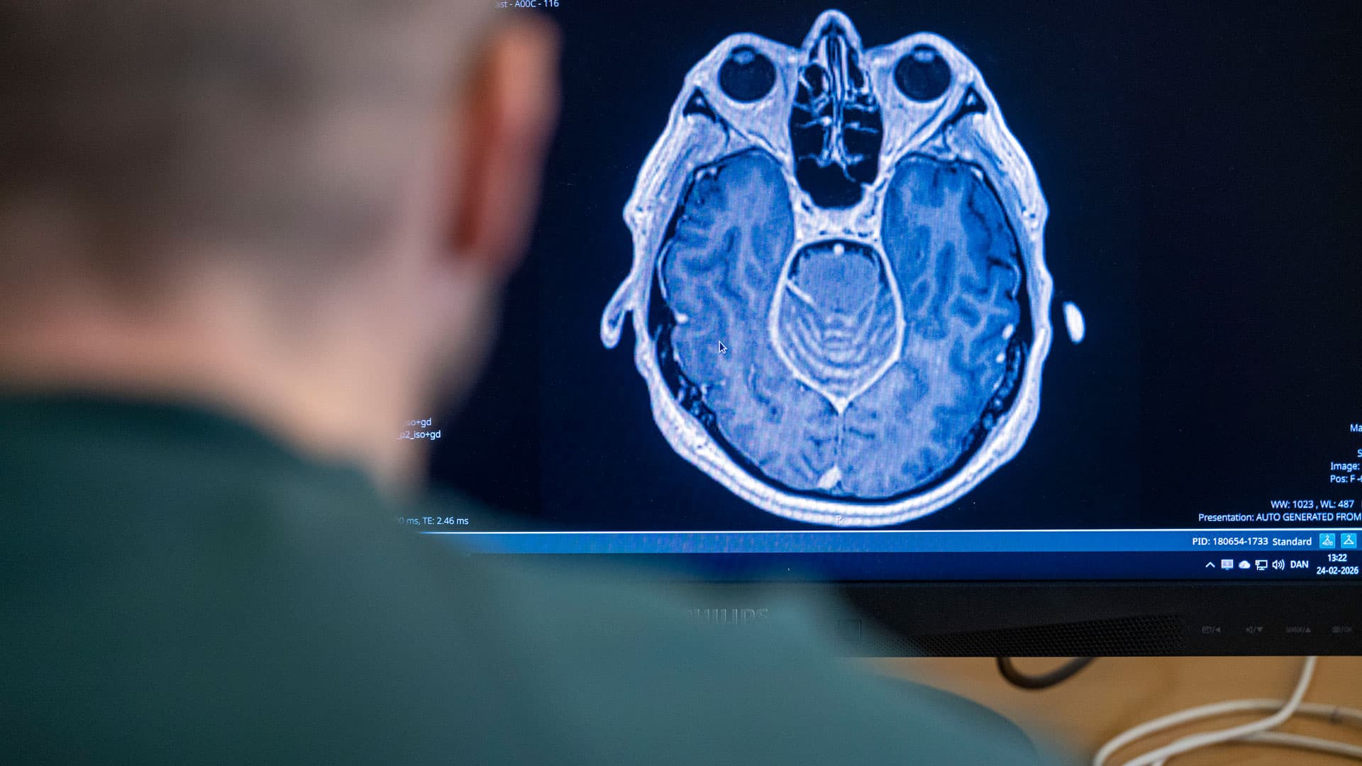 Ser på skanningsbillede af patient med cardiacancer, metastaser i hjernen og hydrocefalus – vand i hovedet. Jens Jakob Riis vurderer, at sygdommen er for fremskreden til operation og anbefaler hospice. Patienten dør på hospice to dage senere. Foto: Lars Horn / Baghuset. 