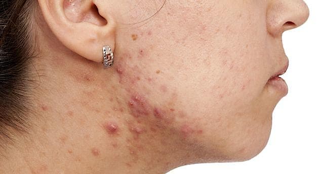 Acne - brugen af antibiotika skal begrænses ved behandlingen. (Foto: Colourbox)