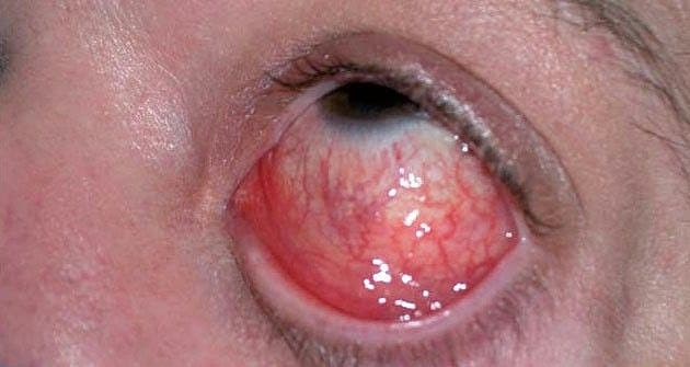 Øjenbetændelse (conjunctivitis) forårsaget af Neisseria gonorrhoeae.