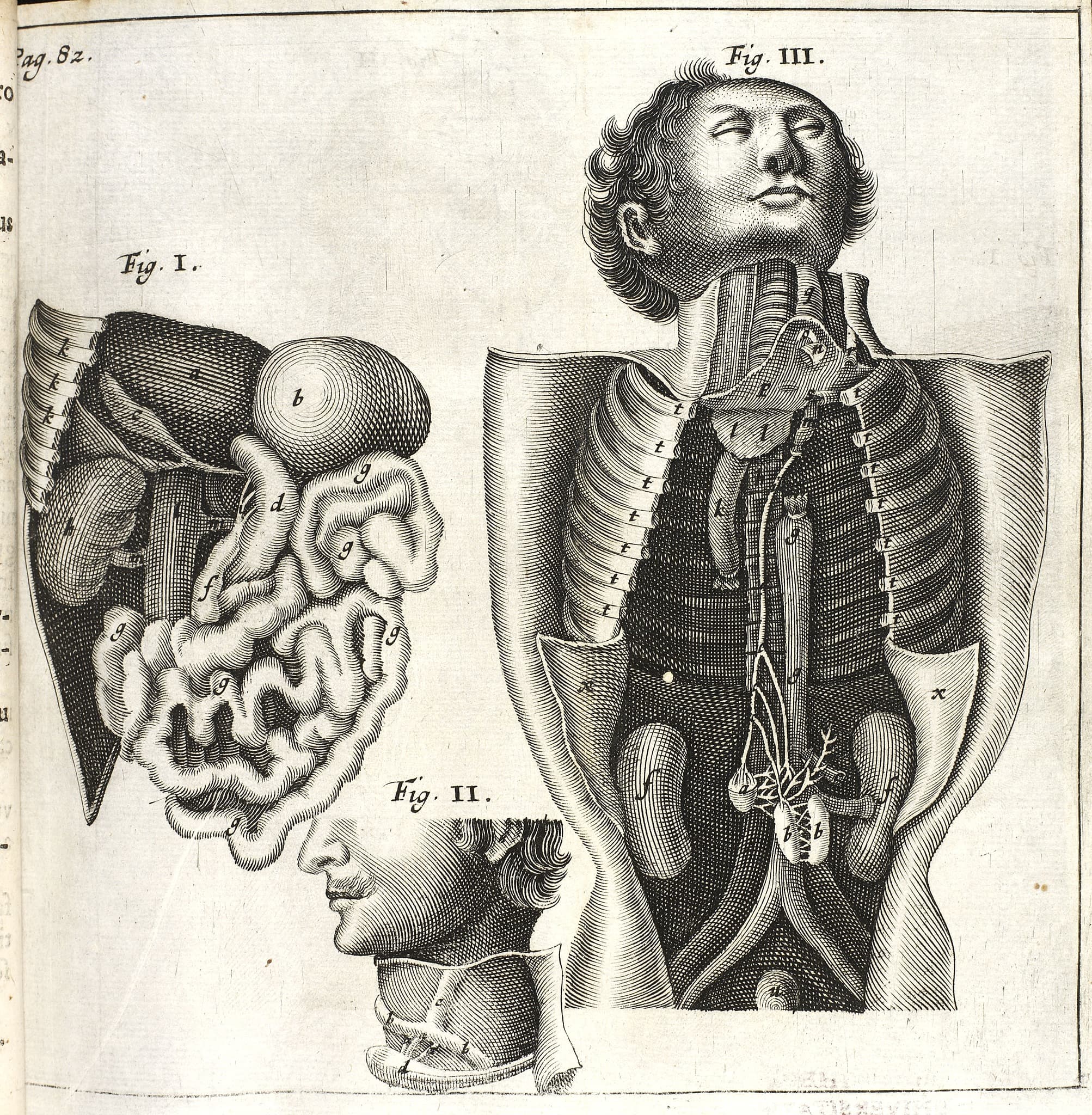 ”Den magre barnemorder”. Ill. viser bl.a. bughulen med de nyfundne chyluskirtler (f) og de fraførende chyluskar (i). Kobberstik af Albert Haelwegh efter forlæg af Karel van Mander.