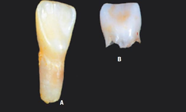 © (Billedet er udlånt med venlig tilladelse af Michael P. Whyte, Shriners Hospital for Children, St. Louis, Missouri, USA).