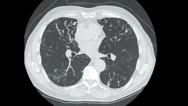 © Højresolutions-CT-billede af bronkiektasier.