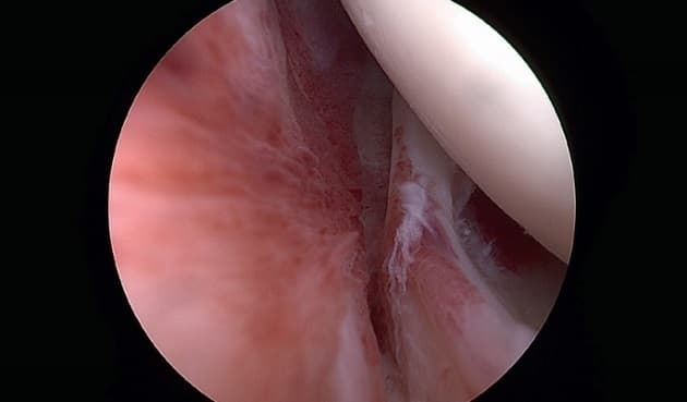 ©. Artroskopibillede med akut synovitis og kontraktur af rotatorintervallet. 