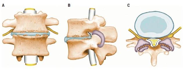 ©. Lumbal spinalstenose på degenerativ basis