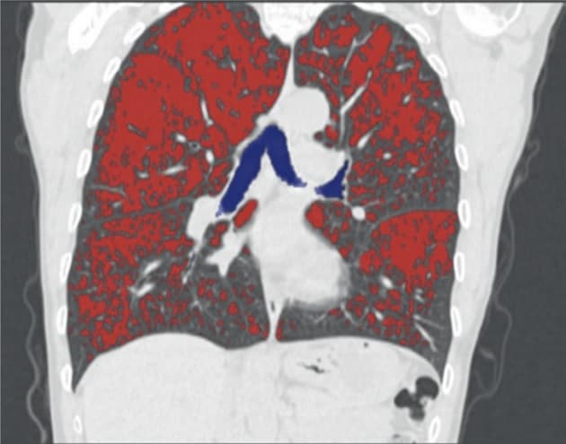 © Med CT-software visualiseres emfysemfordelingen i lungerne, markeret med rødt.