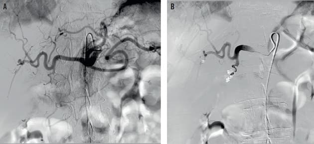 A. Fremstilling af truncus caeliacus, foretaget på makrokateter med spidsen i truncus. B. Efter coiling i a. gastroduodenale foretaget via mikrokateter i a. hepatica communis.