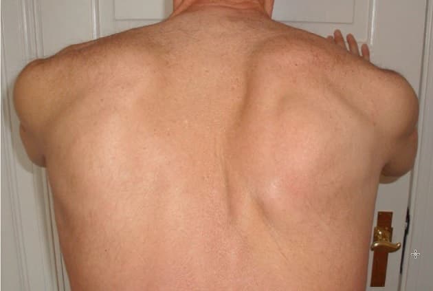 ©. Højresidig scapuladiskinesi.