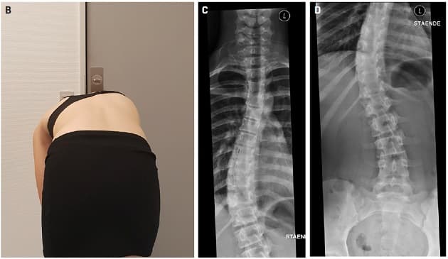©. Pige med S-formet torakolumbal skoliose. B. Klinisk billede med patienten i foroverbøjet stilling. C. Den torakale del af skoliosen. D. Den lumbale del af skoliosen.