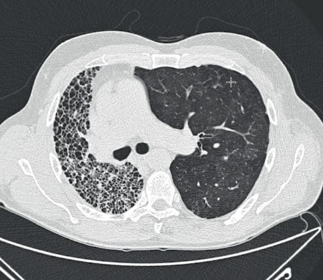 ©. Enkeltlungetransplanteret patient med idiopatisk pulmonal fibrose. Til venstre ses den native lunge.