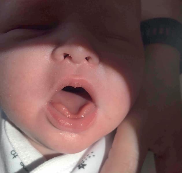 ©. Nyfødt, der ikke kan løfte spidsen af tungen.